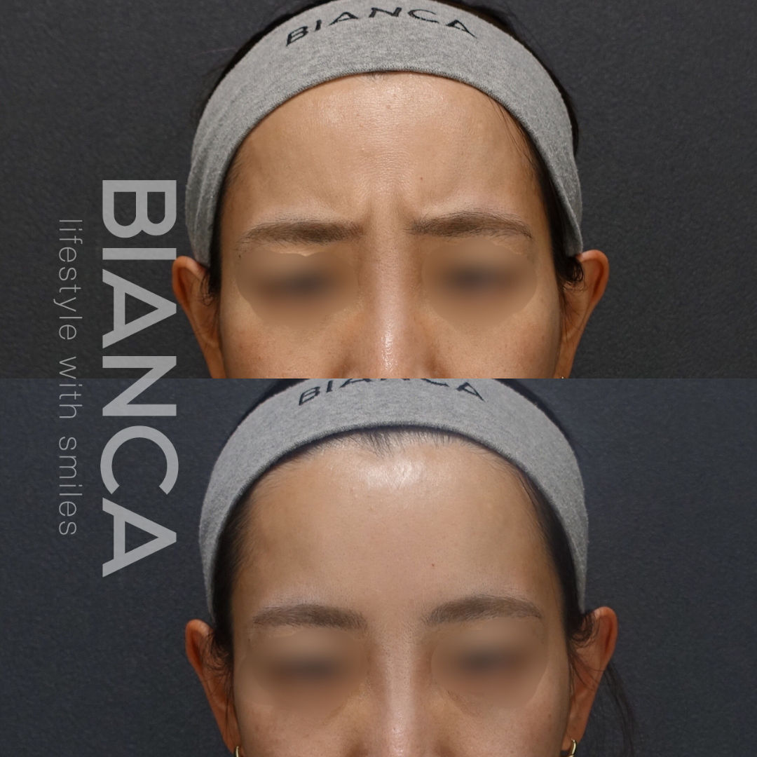 額＋眉間ボトックス