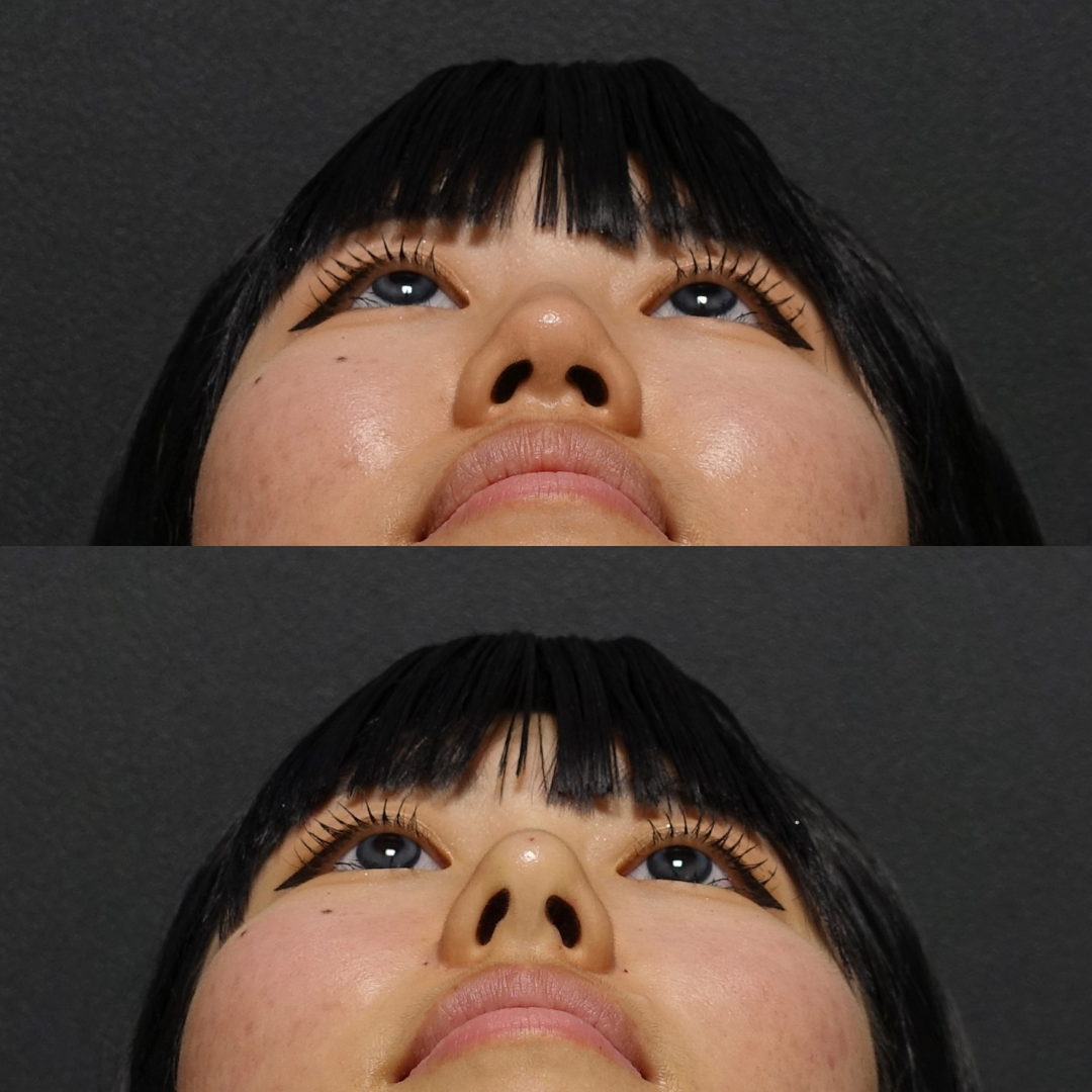 口元の突出感を改善