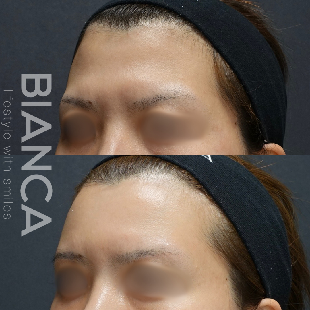 額 脂肪注入