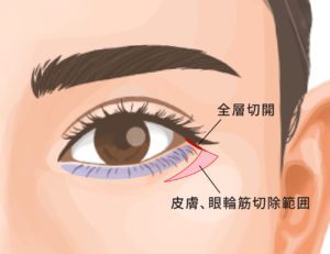 タレ目尻切開 ビアンカ銀座｜銀座・表参道にあるBIANCA CLINIC ビアンカクリニック｜美容外科・美容皮膚科・再生医療・美容婦人科・美容内科・医療アートメイク