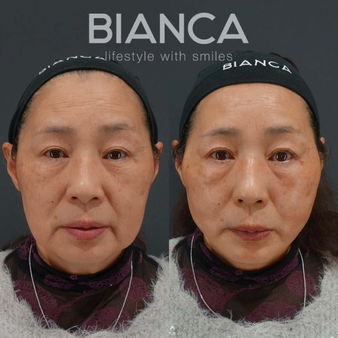 BIANCA LIFT