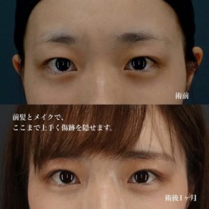 眉下切開