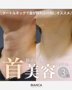 首のシワの原因とケア方法を徹底解説！縦ジワ・横ジワ・ちりめんジワが気になるあなたへ。