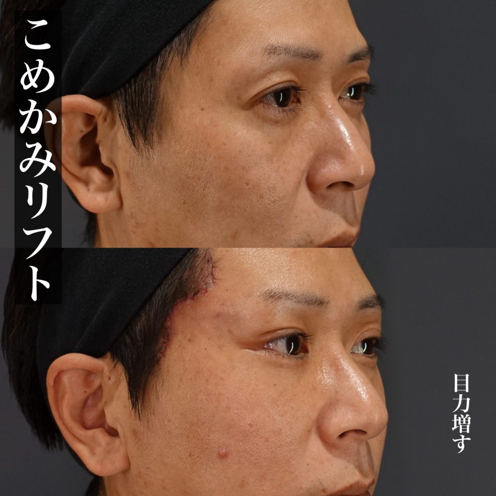 こめかみリフト症例からアプローチの違いを解説