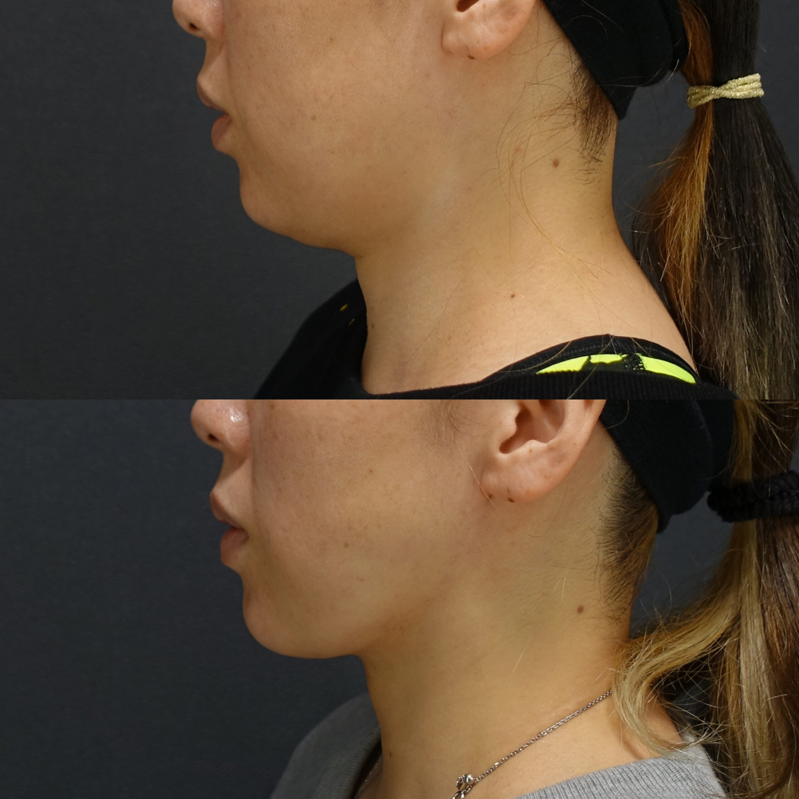 小顔の最強コンビ（脂肪吸引×糸リフト）