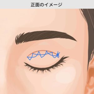 二重埋没法 自然癒着法 銀座・表参道にあるBIANCA CLINIC ビアンカクリニック｜美容外科・美容皮膚科・再生医療・美容婦人科・美容内科・医療アートメイク