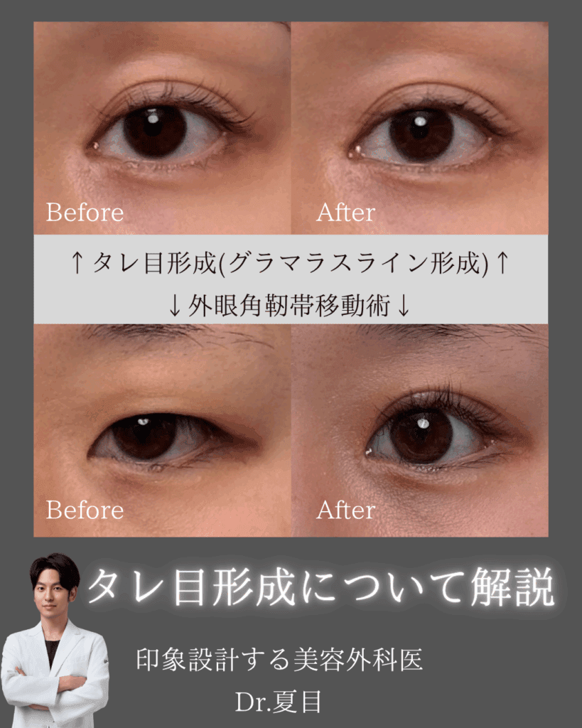 非公開: つり目が気になる方必見！タレ目形成or外眼角靭帯移動？