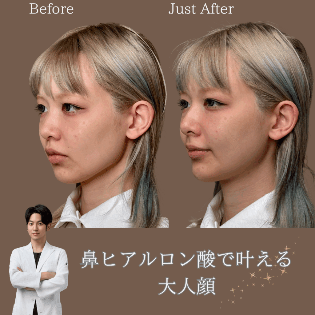 非公開: 鼻ヒアルロン酸で叶える大人顔
