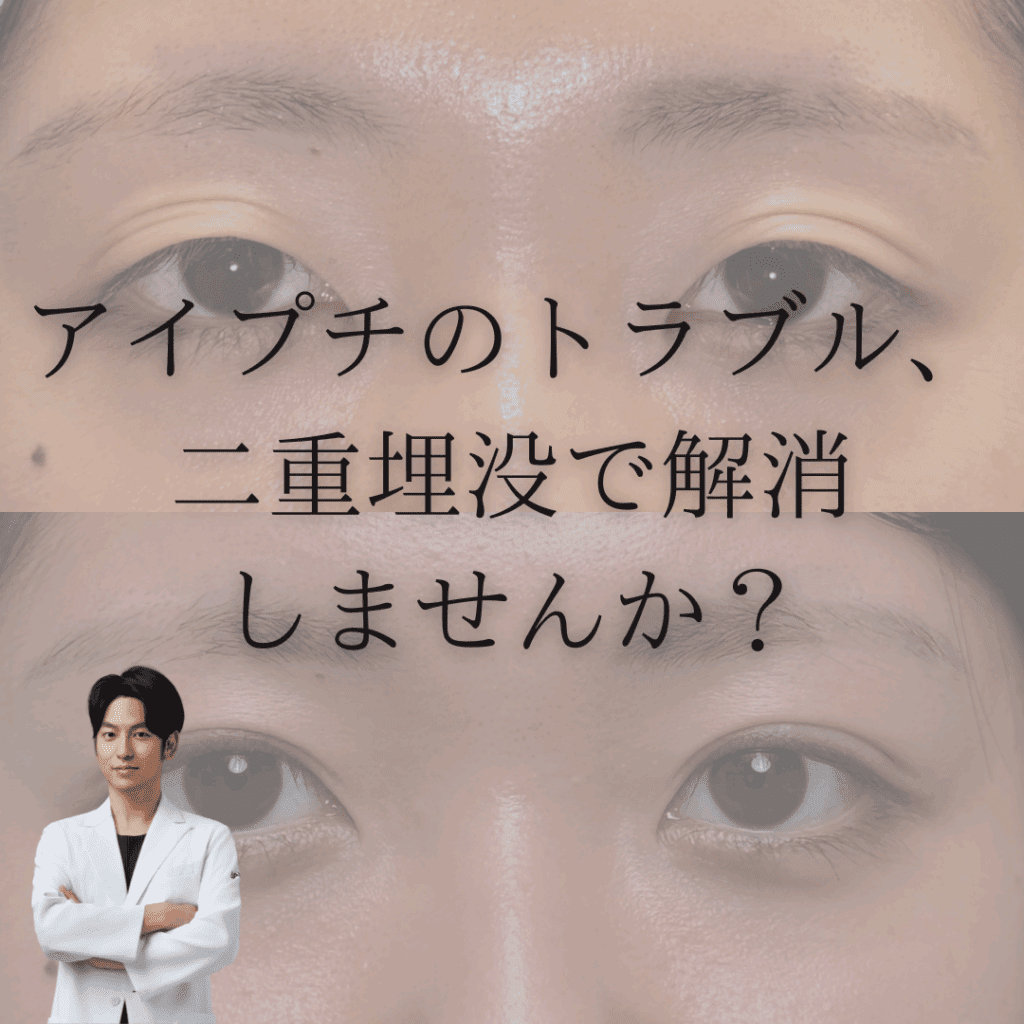 非公開: アイプチのトラブル、二重埋没で解消しませんか？