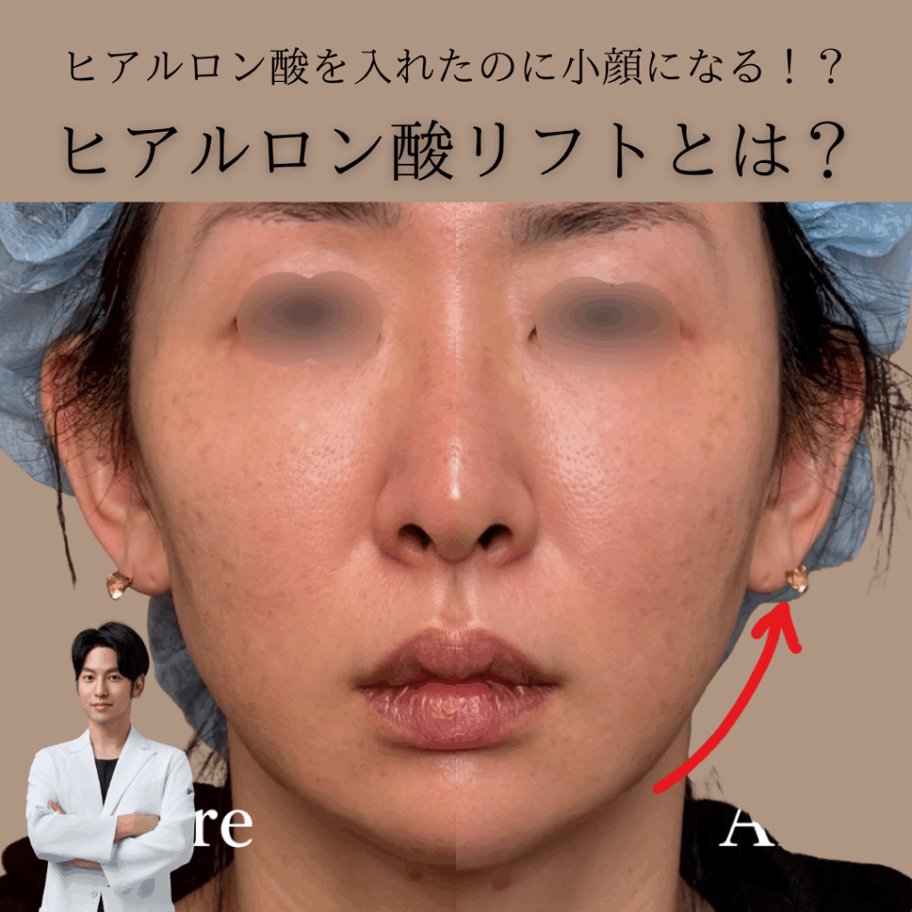 Privado: ヒアルロン酸を入れたのに小顔になる！？ヒアルロン酸リフトとは？