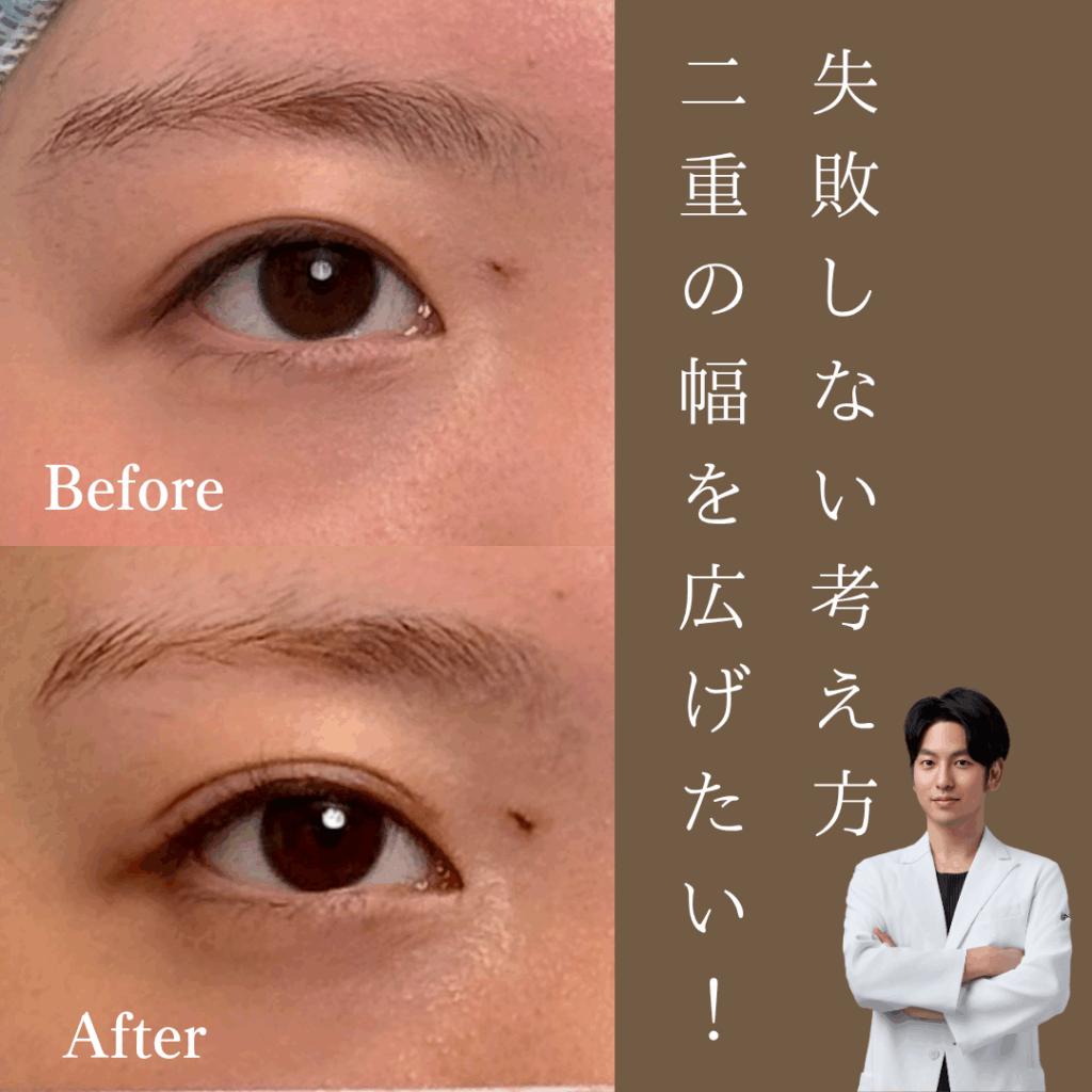 非公開: 二重の幅を広げたい！失敗しないために二重整形の考え方を学ぼう