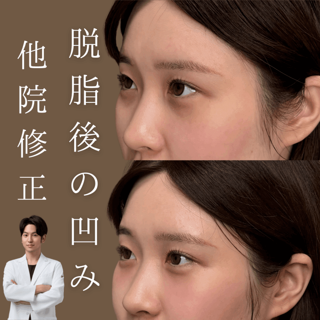 非公開: 脱脂後の凹み、治します！