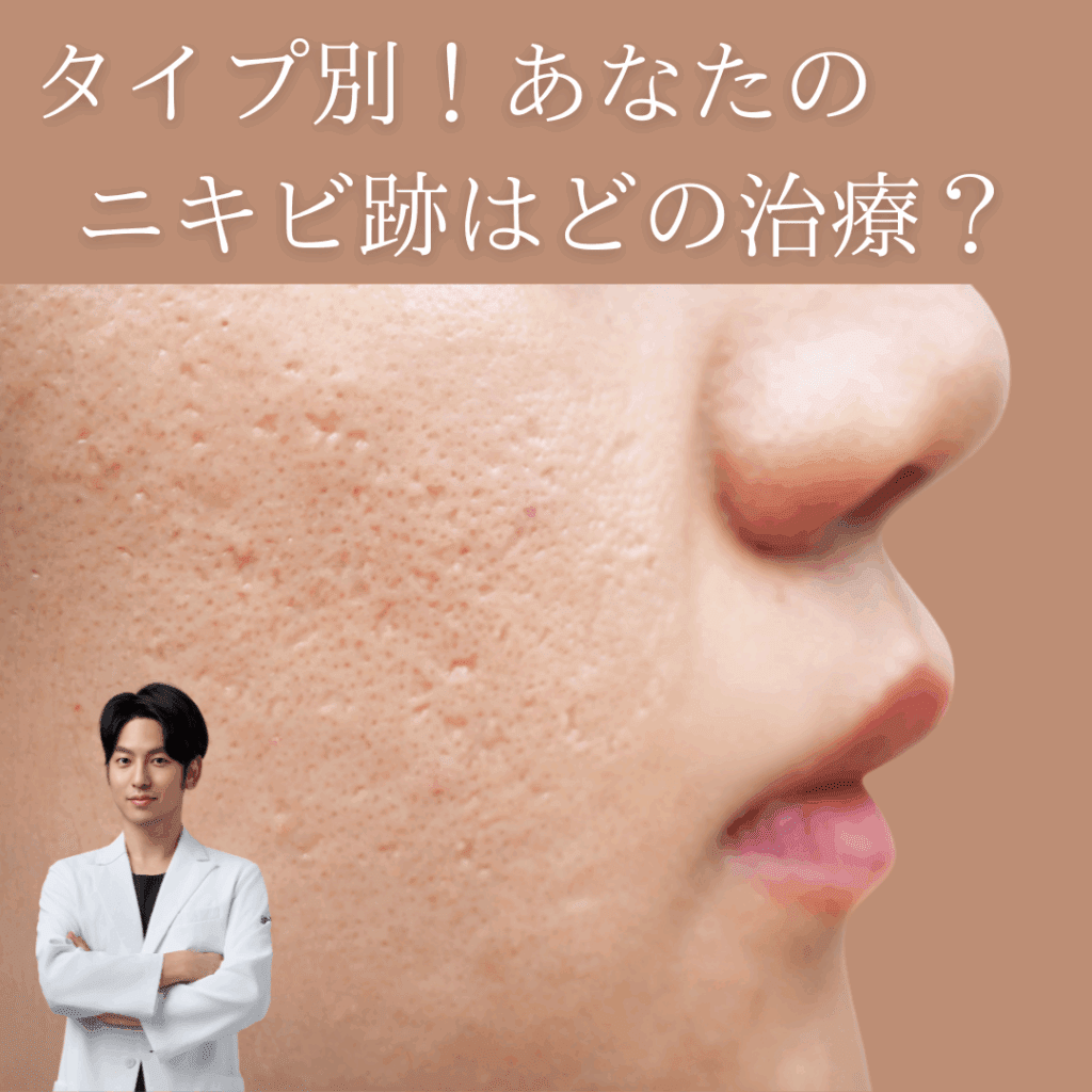 非公開: タイプ別！あなたのニキビ跡はどの治療法？