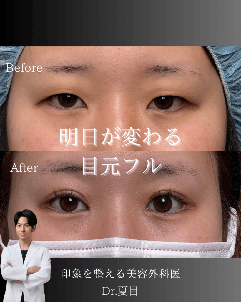 非公開: 印象激変の目元フル整形