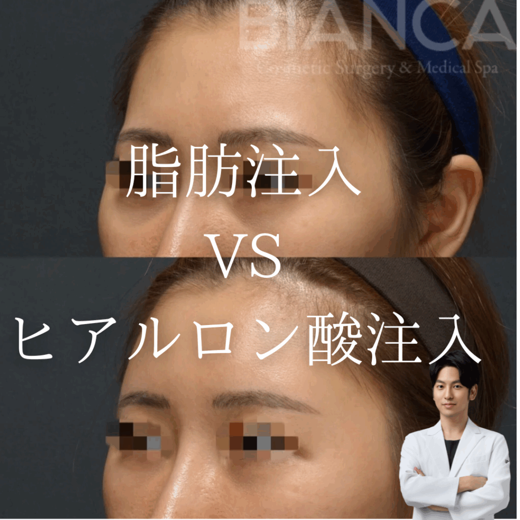 非公開: 脂肪注入vsヒアルロン酸、顔のボリューム不足にはどちらがいいの？