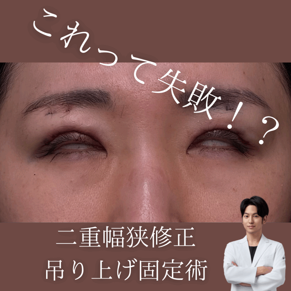 非公開: 目が閉じない？二重幅狭修正、吊り上げ固定術