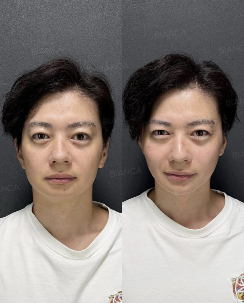 今年のたるみは今年の内に！BIANCAの糸リフト