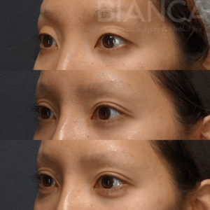 埋二重のデザインの決め方｜ビアンカ銀座｜日本を代表する美容健康再生医療のクリニック