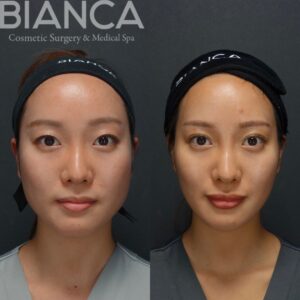 二重埋没法と二重切開法の違い｜ビアンカ銀座｜日本を代表する美容健康再生医療のクリニック