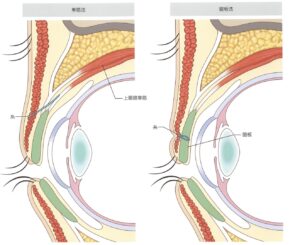 まぶたが厚い・脂肪が多いと二重埋没法は難しい？適応と限界｜ビアンカ銀座｜日本を代表する美容健康再生医療のクリニック