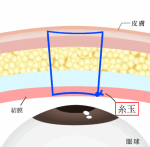埋没は結局何法がいいの？固定法・表留め/裏留めを比較｜ビアンカ銀座｜日本を代表する美容健康再生医療のクリニック