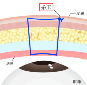 埋没は結局何法がいいの？固定法・表留め/裏留めを比較｜ビアンカ銀座｜日本を代表する美容健康再生医療のクリニック