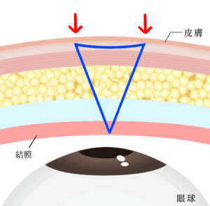 埋没は結局何法がいい？②固定点数・糸のかけ方・糸の種類を比較｜ビアンカ銀座｜日本を代表する美容健康再生医療のクリニック