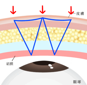 埋没は結局何法がいい？②固定点数・糸のかけ方・糸の種類を比較｜ビアンカ銀座｜日本を代表する美容健康再生医療のクリニック