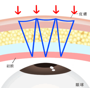 埋没は結局何法がいい？②固定点数・糸のかけ方・糸の種類を比較｜ビアンカ銀座｜日本を代表する美容健康再生医療のクリニック