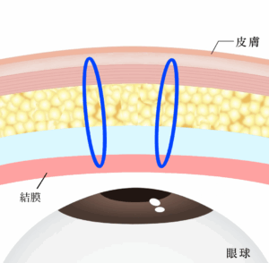 埋没は結局何法がいい？②固定点数・糸のかけ方・糸の種類を比較｜ビアンカ銀座｜日本を代表する美容健康再生医療のクリニック