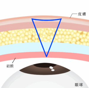 埋没は結局何法がいい？②固定点数・糸のかけ方・糸の種類を比較｜ビアンカ銀座｜日本を代表する美容健康再生医療のクリニック
