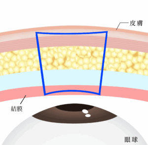 埋没は結局何法がいい？②固定点数・糸のかけ方・糸の種類を比較｜ビアンカ銀座｜日本を代表する美容健康再生医療のクリニック