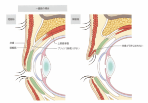 「二重になる原理」と「全切開でできること」｜ビアンカ銀座｜日本を代表する美容健康再生医療のクリニック
