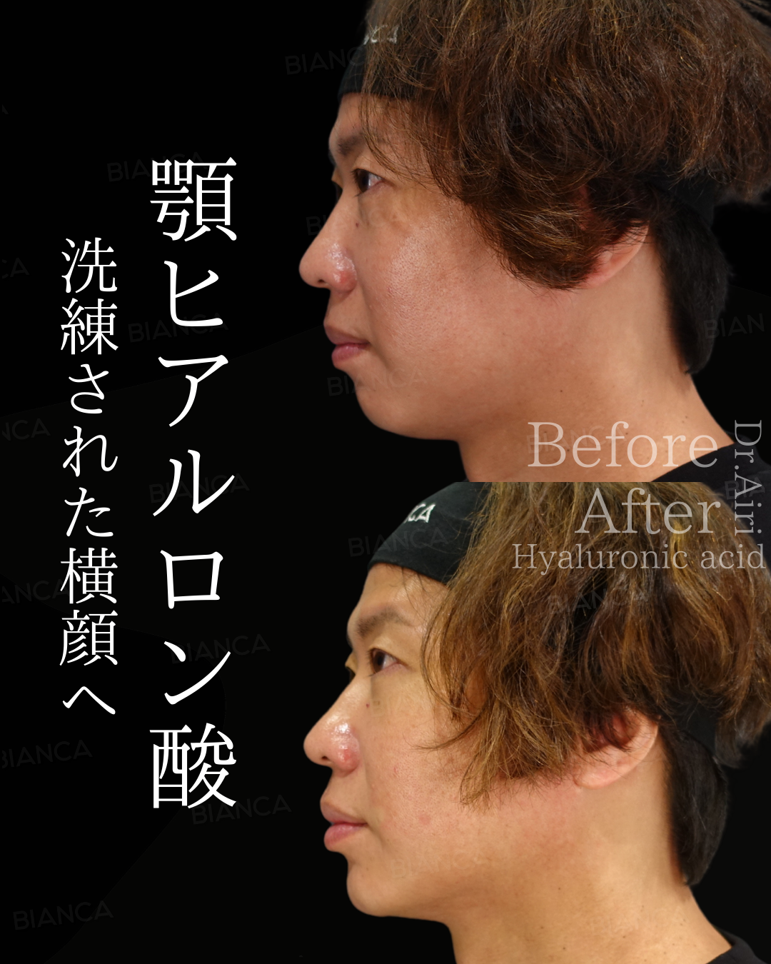 ヒアルロン酸注射