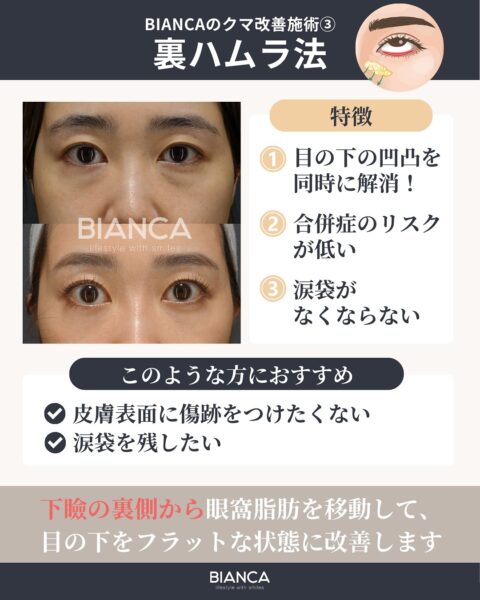 裏ハムラ法 銀座・表参道にあるBIANCA CLINIC ビアンカクリニック｜美容外科・美容皮膚科・再生医療・美容婦人科・美容内科・医療アートメイク