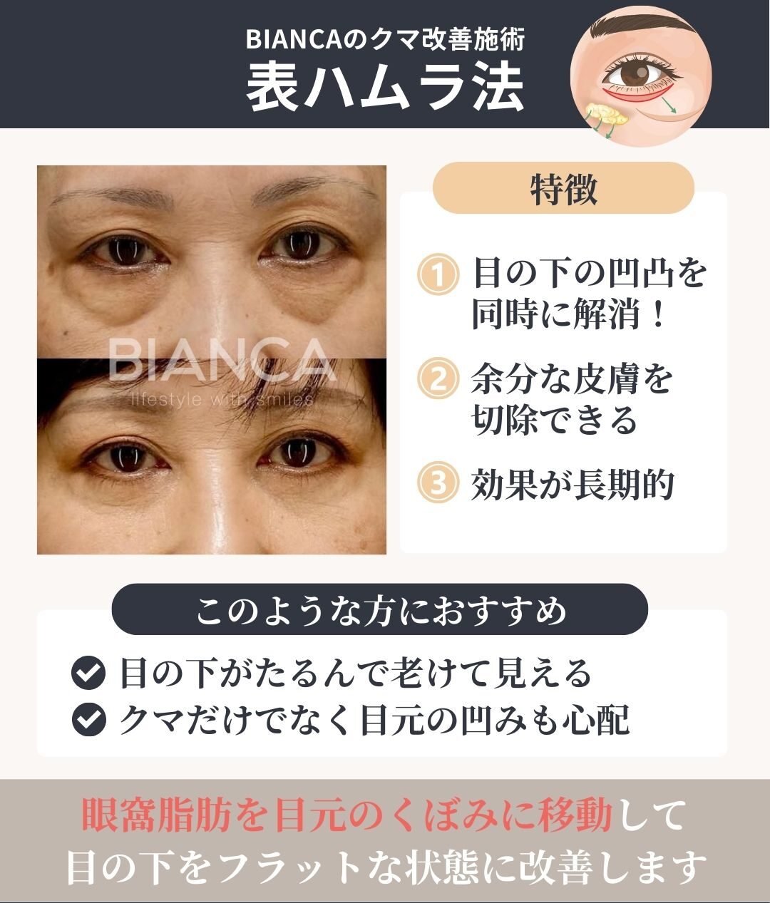 ハムラ法とは