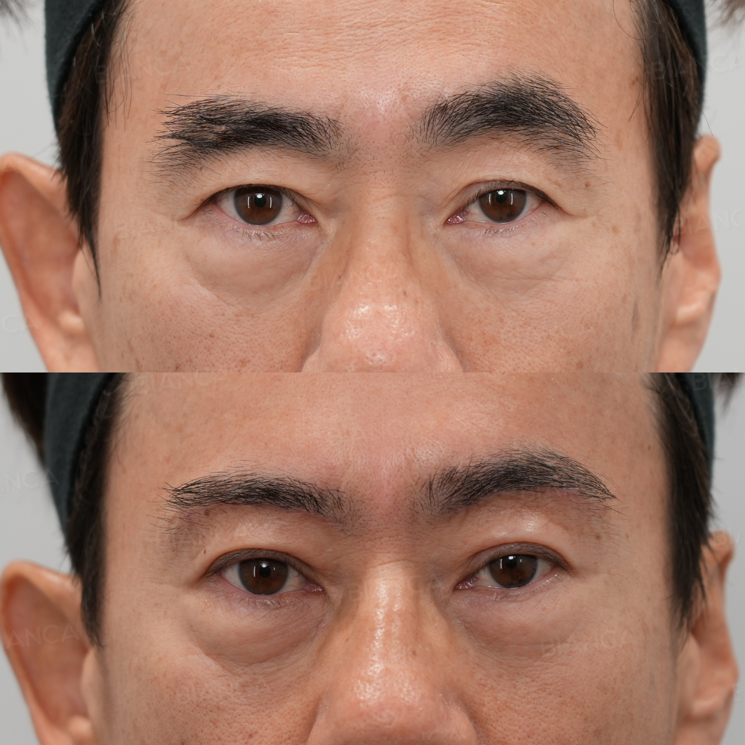 眉下切開