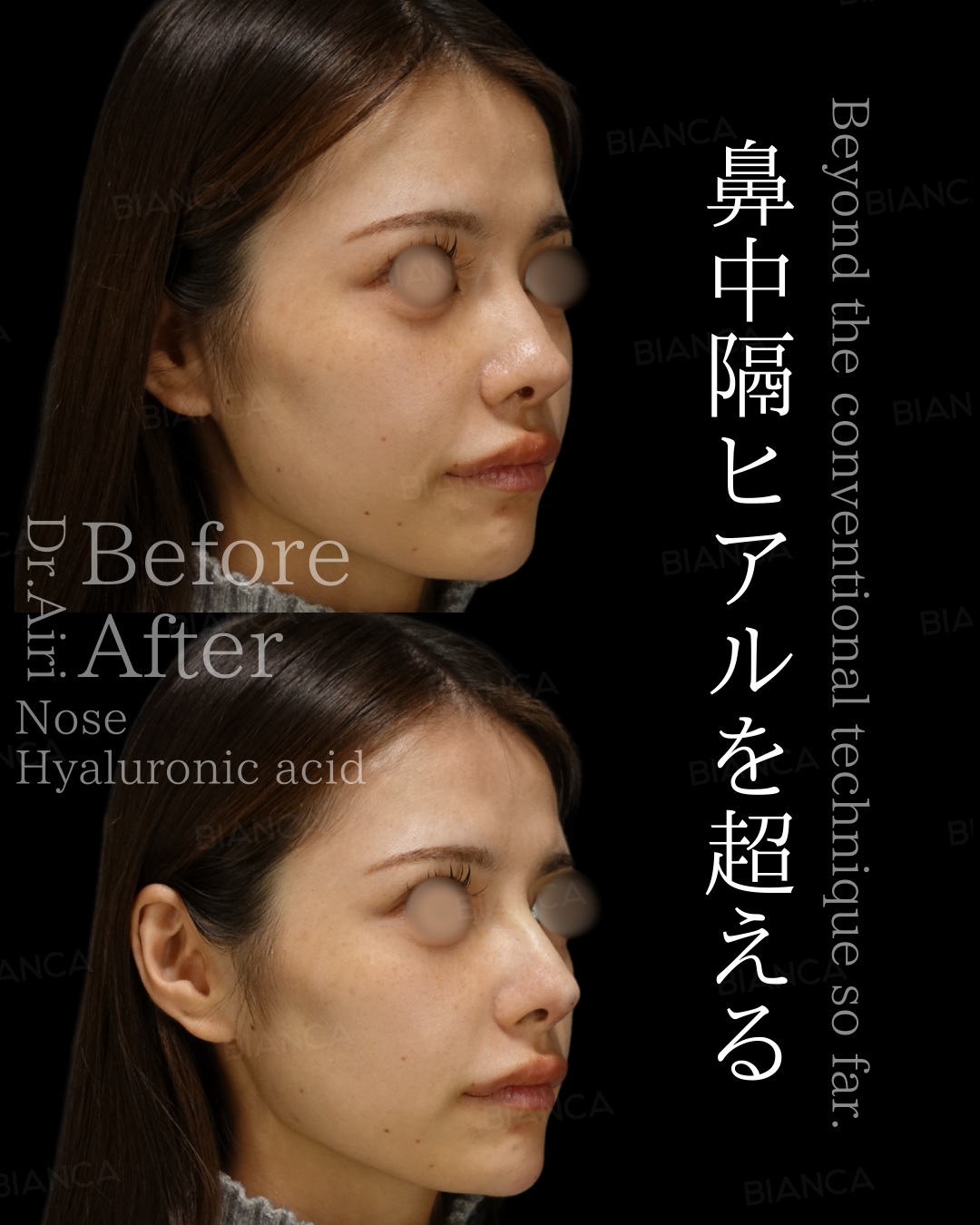 ヒアルロン酸注射