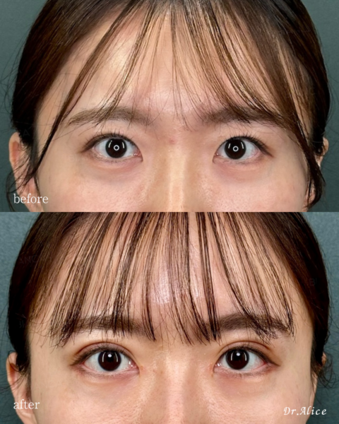 Alice’s EYE Method｜顔全体からデザインする目元の拡大メソッド｜銀座・表参道にあるBIANCA CLINIC ビアンカクリニック｜美容外科・美容皮膚科・再生医療・美容婦人科・美容内科
