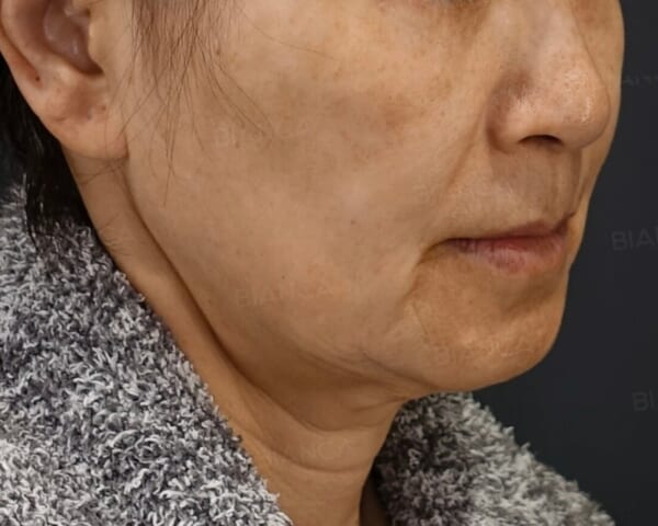 【症例解説】切らないたるみ治療で、ここまで若返る｜銀座・表参道にあるBIANCA CLINIC ビアンカクリニック｜美容外科・美容皮膚科・再生医療・美容婦人科・美容内科
