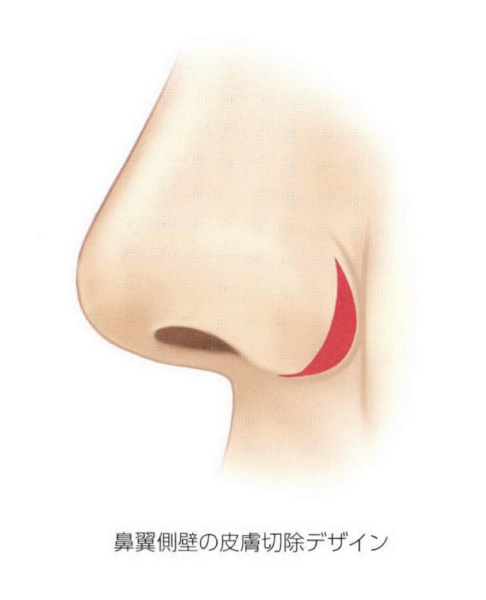 小鼻縮小（鼻翼縮小）の種類と切開位置の違い｜ビアンカ銀座｜日本を代表する美容健康再生医療のクリニック