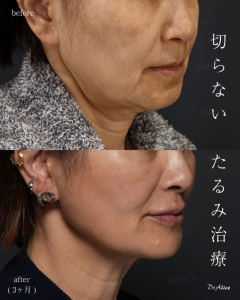 【症例解説】切らないたるみ治療で、ここまで若返る｜銀座・表参道にあるBIANCA CLINIC ビアンカクリニック｜美容外科・美容皮膚科・再生医療・美容婦人科・美容内科