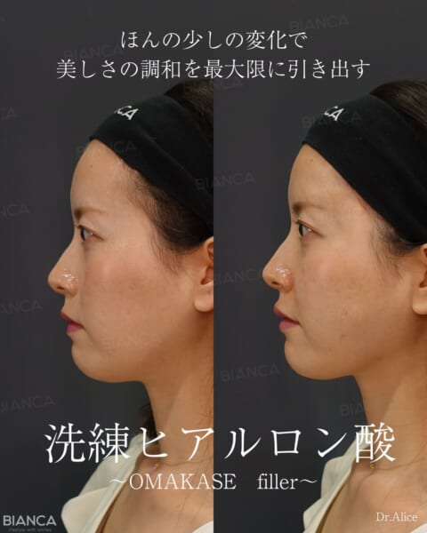 黄金比は不要？その人に合ったヒアルロン酸注入で横顔の美しさを引き出す。｜銀座・表参道にあるBIANCA CLINIC ビアンカクリニック｜美容外科・美容皮膚科・再生医療・美容婦人科・美容内科