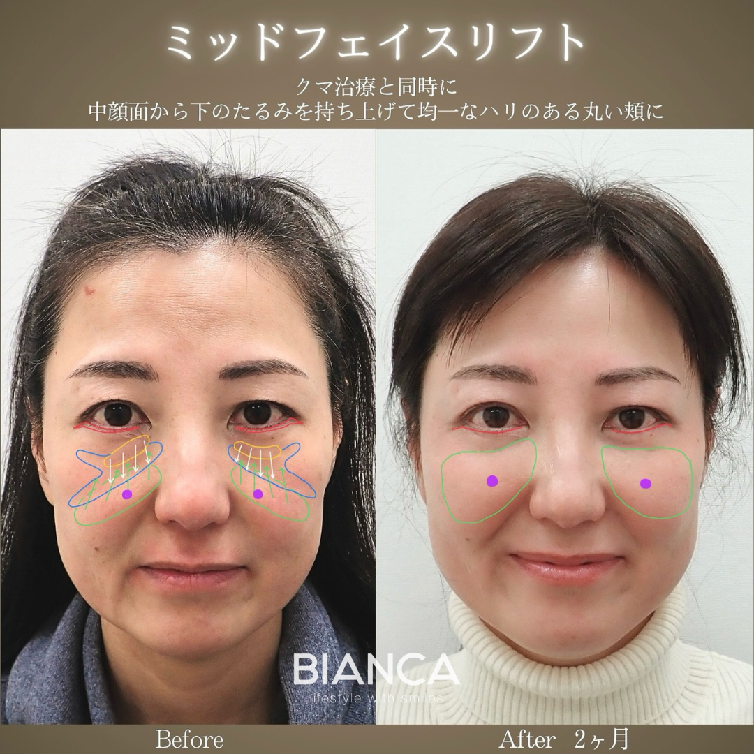 ミッドフェイスリフト