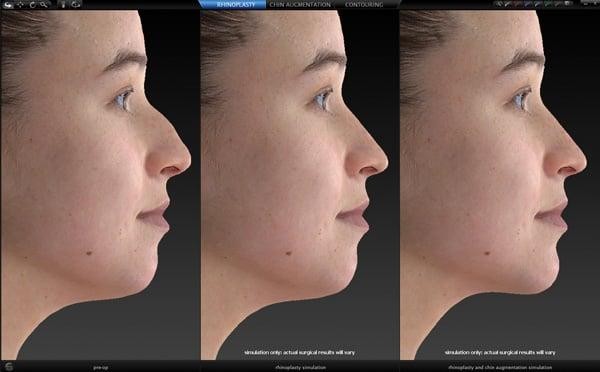 3Dシミュレーションシステム“ベクトラ”で施術後の仕上がりを確認