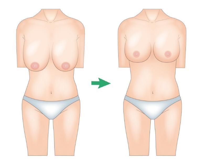 乳房縮小術とは