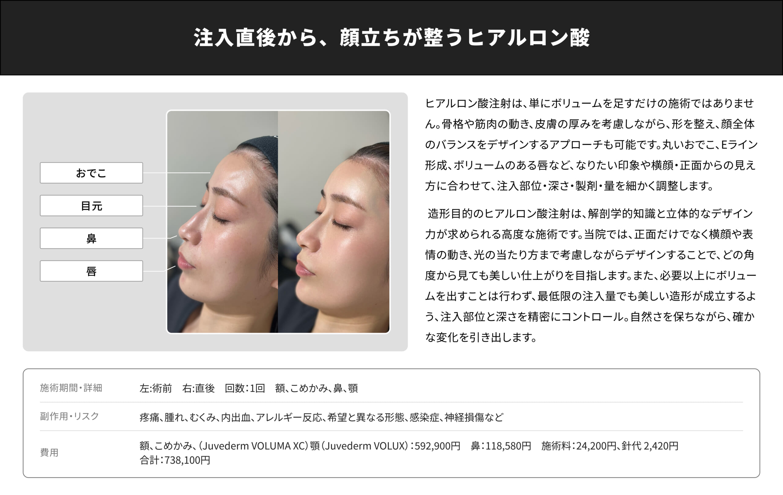 ヒアルロン酸注射｜銀座・表参道にあるBIANCA CLINIC ビアンカクリニック｜美容外科・美容皮膚科・再生医療・美容婦人科・美容内科