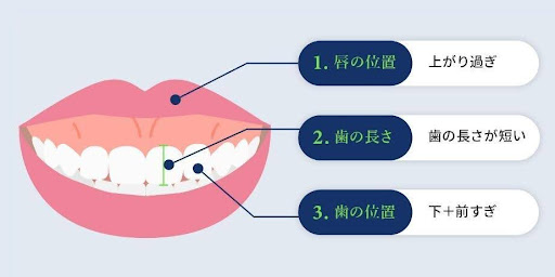 ガミースマイルはなぜ起こる？審美歯科で自然な笑顔へ｜ビアンカの審美歯科医 築山鉄平が解説！｜ビアンカ銀座｜日本を代表する美容健康再生医療のクリニック
