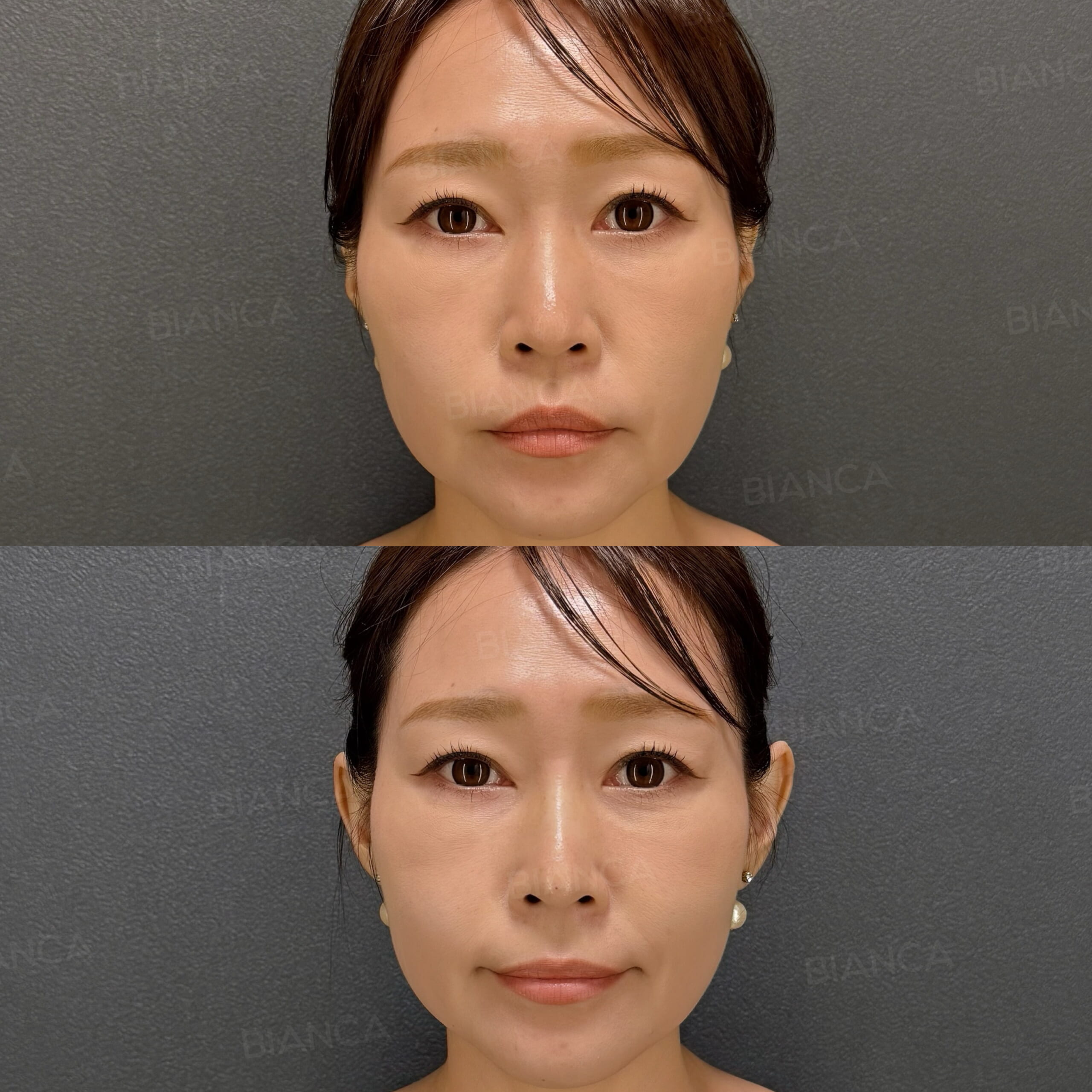 立ち耳ヒアルロン酸