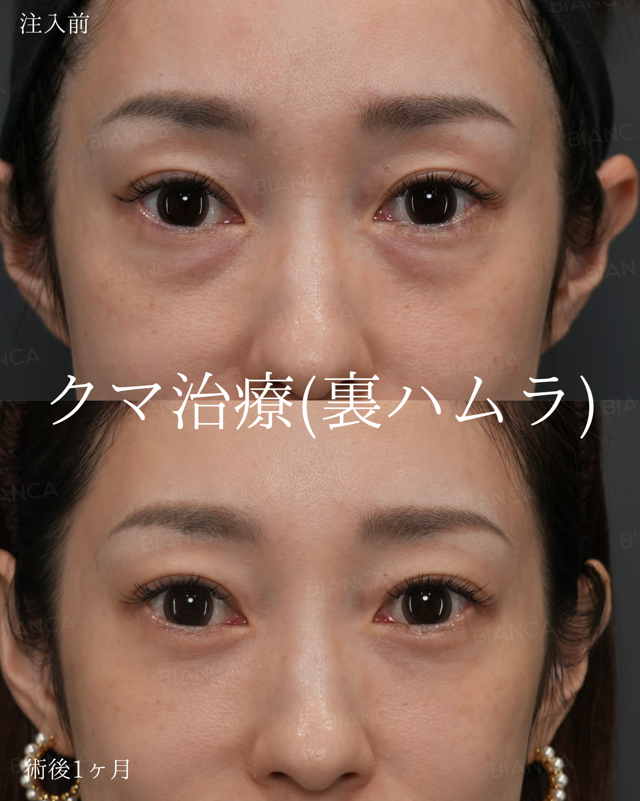 裏ハムラ法
